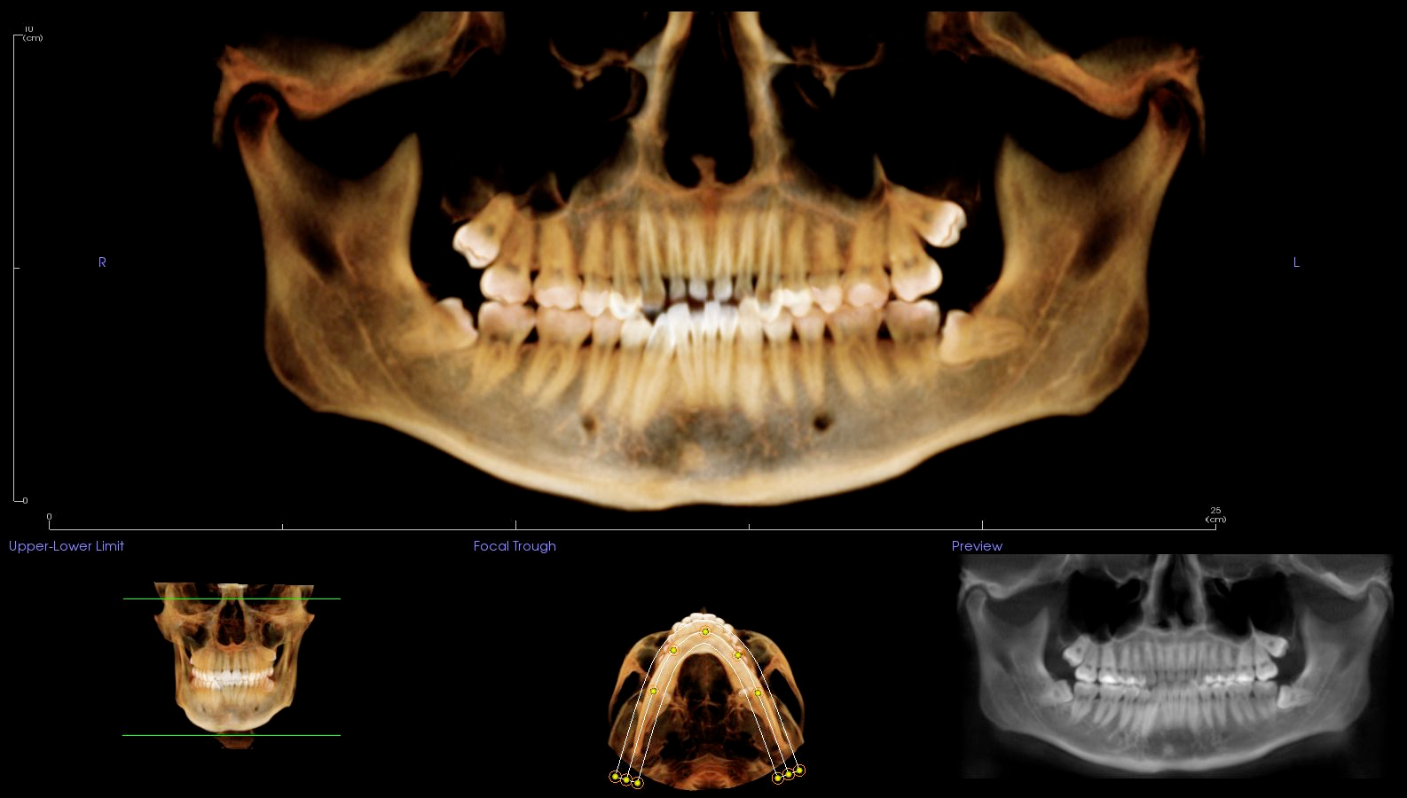 wisdom teeth cbct scan image